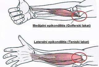 bol u lakatnom zglobu prilikom savijanja uzroka bol u ramenskom zglobu lijeve ruke simptomi